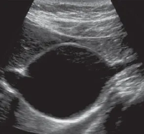 Choledochal cyst Type I