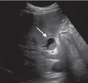 Choledochal cyst Type II