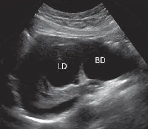 Choledochal cyst Type IV