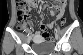 Acute appendicitis on CT scan