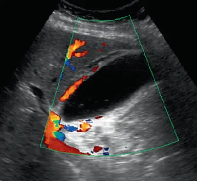 Acute cholecystitis Doppler