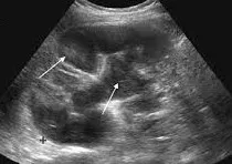 Pyelonephritis