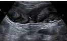 Appendiceal mucocele ultrasound