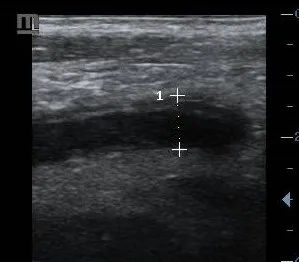 Acute appendicitis ultrasound