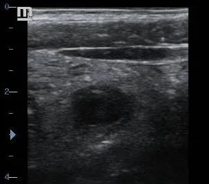 Acute appendicitis transverse target sign