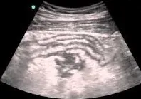 Perforated appendicitis imaging