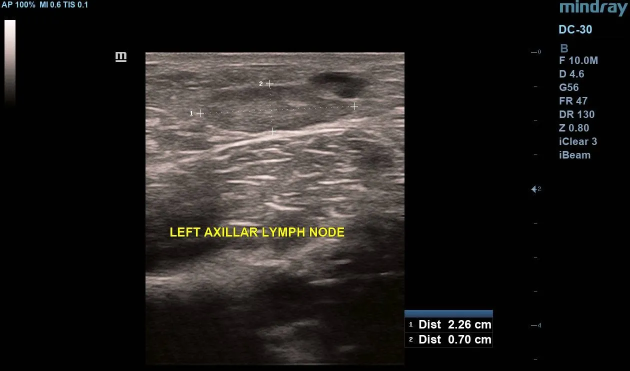 Grayscale ultrasound of the left axilla demonstrating a reactive lymph node with concentric cortical thickening but a preserved fatty hilum.