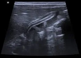 Biliary ascariasis tubular structure