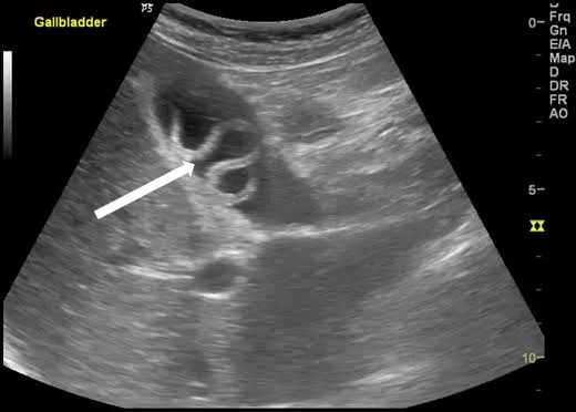 Biliary ascariasis spaghetti sign