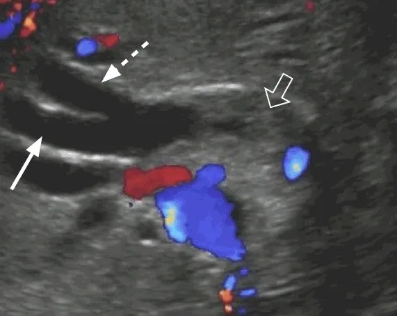 Biliary obstruction