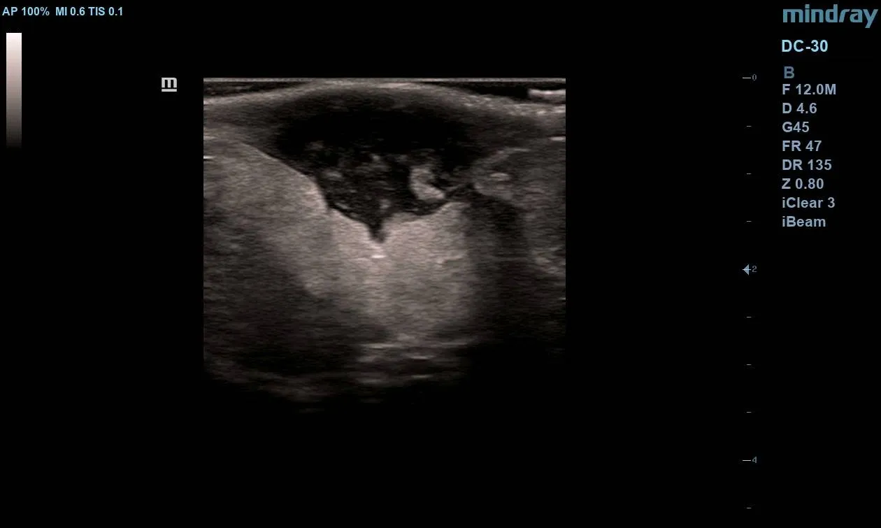 Gray-scale ultrasound scan of the left breast showing a complex cystic lesion with irregular margins and low-level internal echoes.