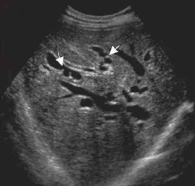 Caroli disease sacculations