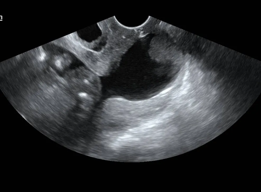 Sonographic visualization of amniotic membranes bulging into the canal creating an hourglass sign.