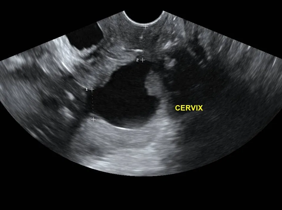 Transvaginal ultrasound showing a markedly shortened cervix measuring 14 mm.
