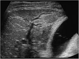 Intrahepatic duct dilation