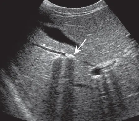 Intrahepatic Choledocholithiasis