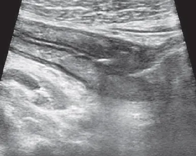 Terminal Ileum in Crohn's