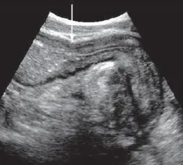 Fibrotic Stricture