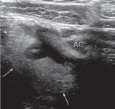 Acute diverticulitis colonic outpocketing