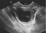 Extrauterine gestation sac ultrasound
