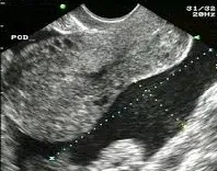 Empty uterus and free fluid in pouch of Douglas ultrasound