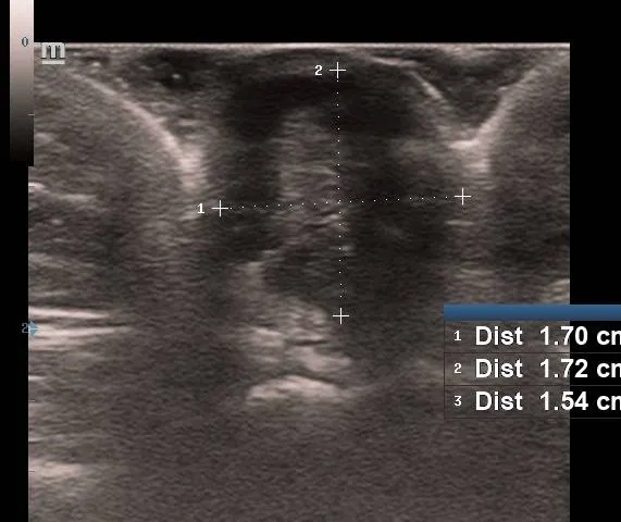 Longitudinal ultrasound view of the umbilical mass showing its position of the umbilical nodule in the subcutaneous tissue relative to the skin surface.