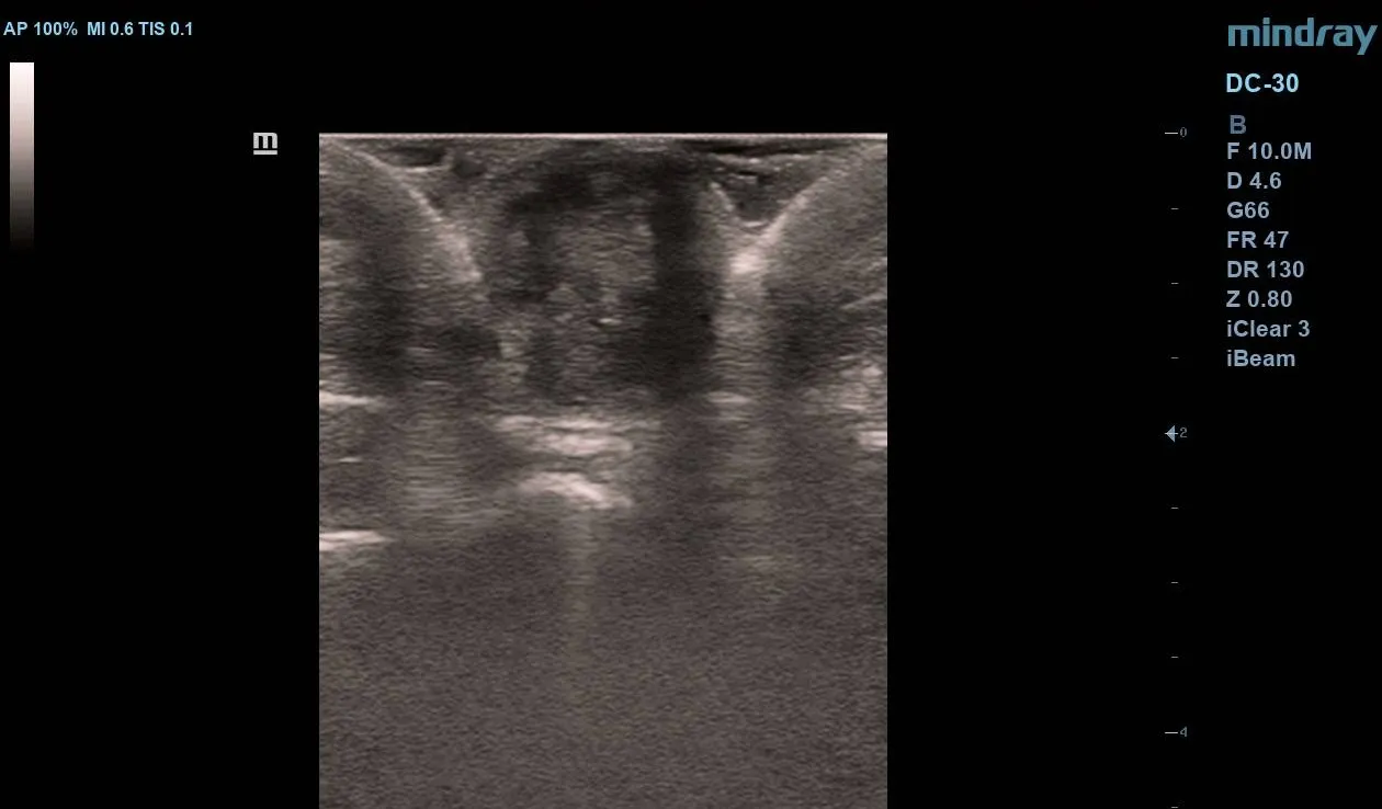 Transverse ultrasound scan of umbilical nodule showing a well-defined hypoechoic solid mass with tiny internal echogenic foci.