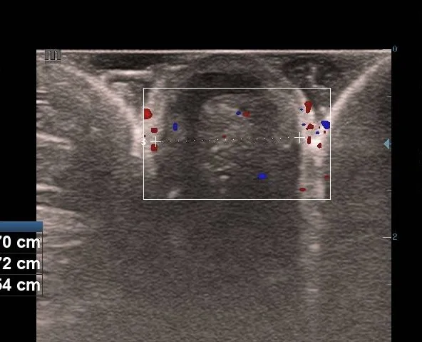 Color Doppler ultrasound of the umbilical nodule showing low-resistance internal and peripheral vascular blood flow.
