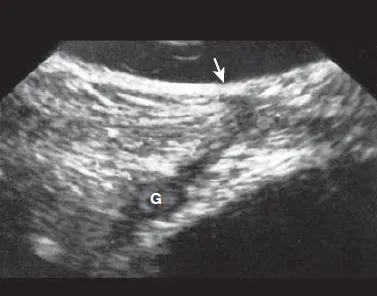 Enterocutaneous Fistula
