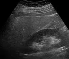 Grade 1 Fatty liver