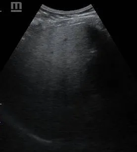Grade 3 Fatty liver
