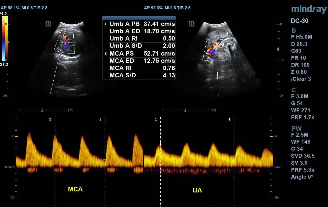Umbilical artery Doppler and Middle cerebral artery doppler