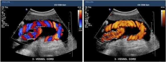 Two side-by-side medical ultrasound scans of a fetal 3-vessel umbilical cord. The left panel shows a color Doppler scan displaying alternating red and blue braided patterns of blood flow. The right panel shows a power Doppler scan of the same coiled cord structure glowing in monochromatic shades of orange and yellow. Both panels include technical ultrasound parameters on the left and a velocity scale on the right