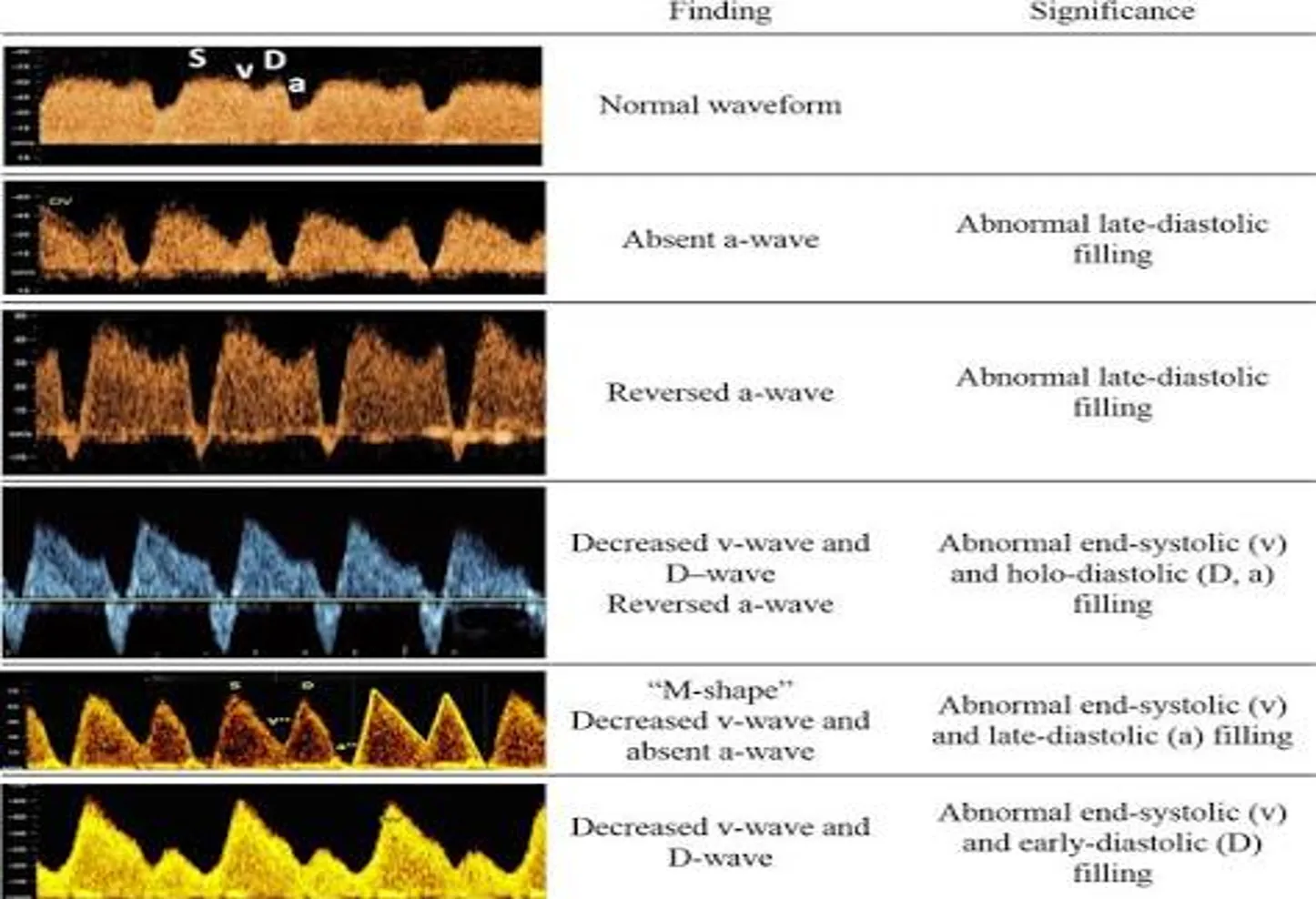 A medical reference table comparing six different spectral Doppler ultrasound waveforms in vertical rows.