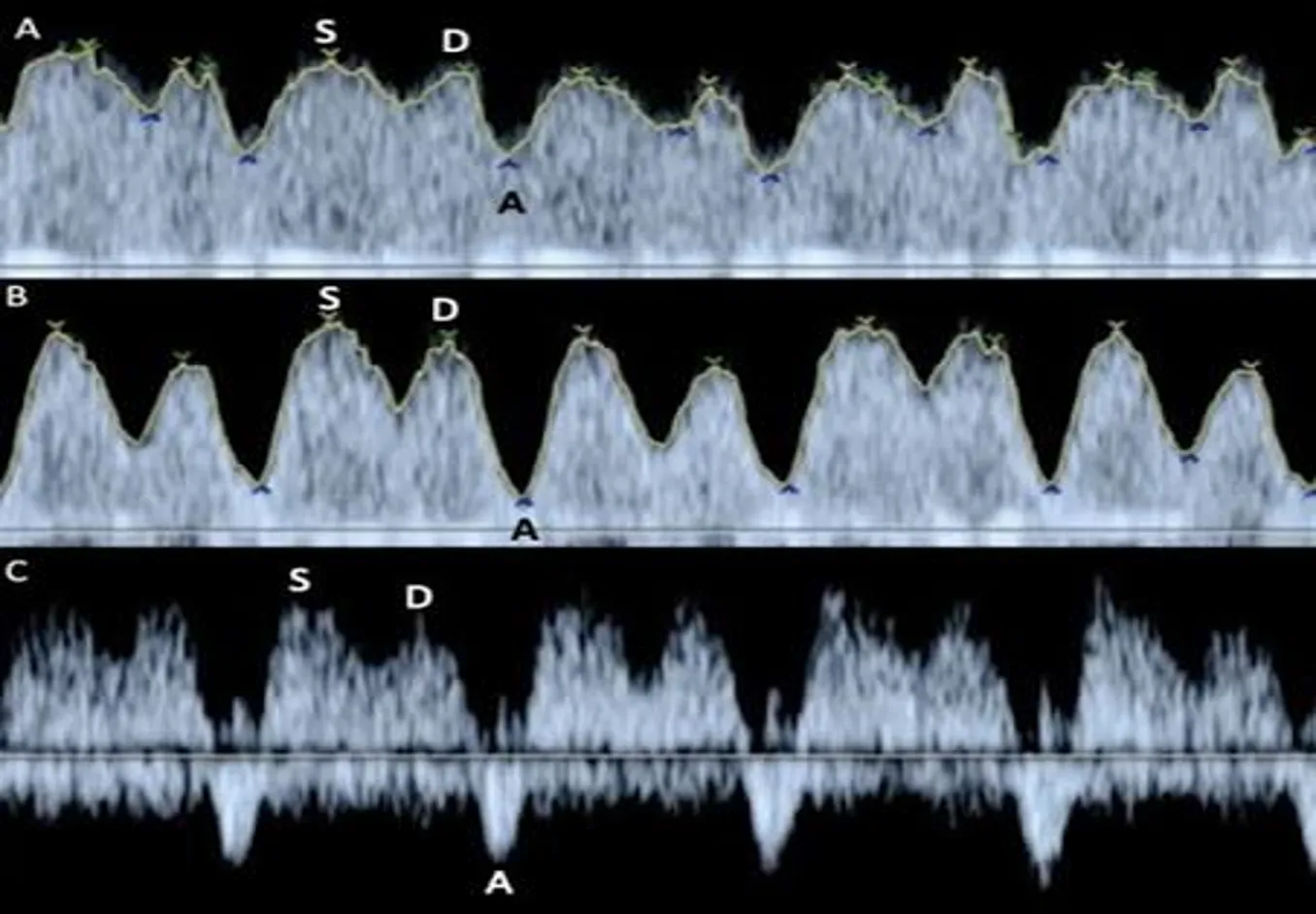 A vertical stack of three spectral Doppler ultrasound waveforms labeled A, B, and C against a black background. Each panel maps a pulsing wave pattern with specific peaks labeled S and D. Panel A shows a shallow waveform, Panel B shows a deeper wave pattern dipping to a baseline letter A, and Panel C shows a spiked waveform that plunges sharply below the baseline at letter A.