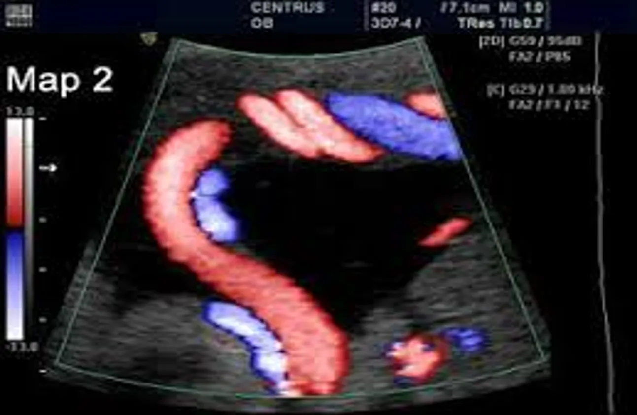 A color Doppler ultrasound scan of an umbilical cord. A thick, curved red vessel loops down the center, surrounded by smaller blue sections against a dark background. A color scale is visible on the left