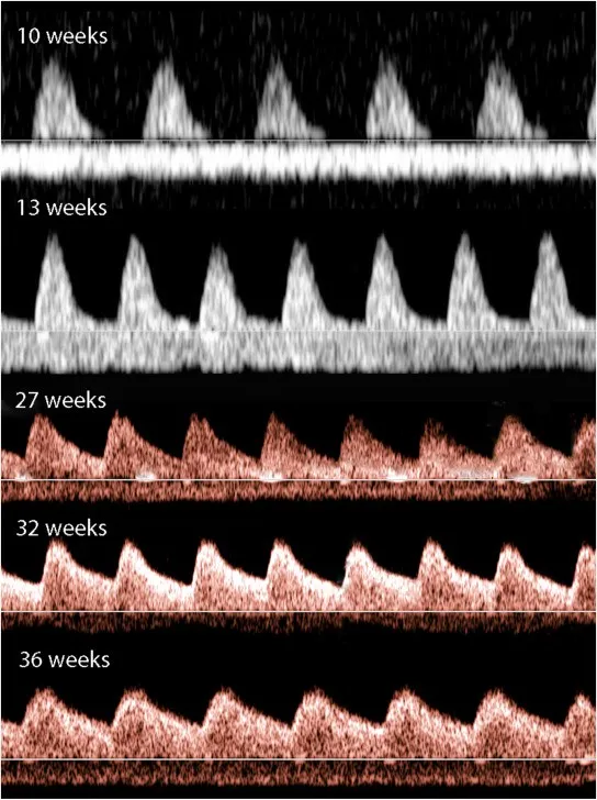 A vertical stack of five spectral Doppler ultrasound waveforms tracking umbilical artery blood flow across different gestational ages: 10 weeks, 13 weeks, 27 weeks, 32 weeks, and 36 weeks.