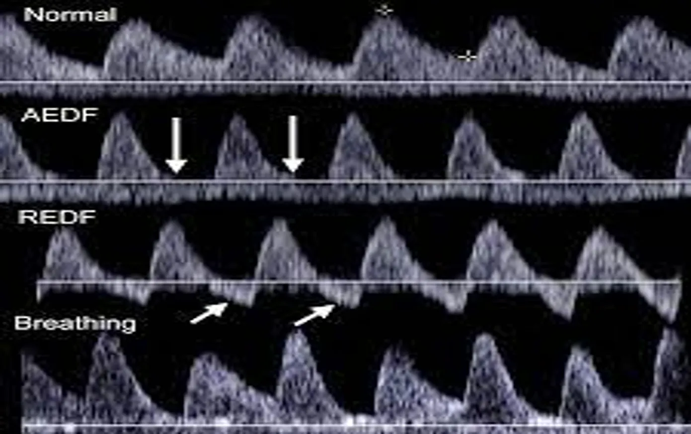 A vertical stack of four spectral Doppler ultrasound waveforms comparing umbilical artery conditions