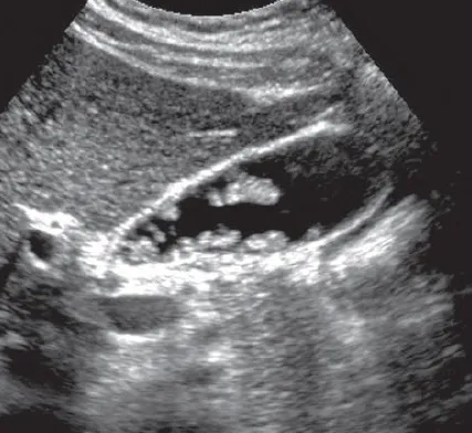 Gallbladder polyp