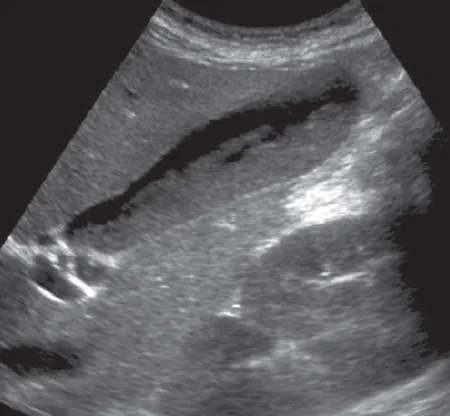 Gallbladder sludge