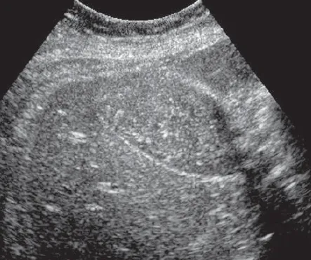 Hepatisation of gallbladder
