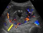 Gastrointestinal Stromal Tumor ultrasound mass
