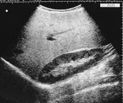 Increased liver echogenicity due to accumulation of glycogen