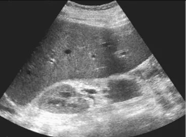 Hepatomegaly due to glycogenosis