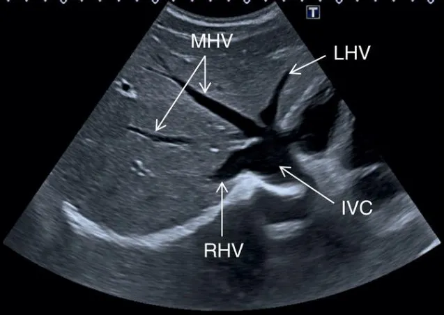 Normal hepatic vessels