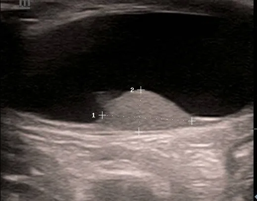 Simple hydrocele