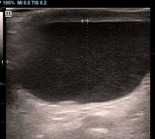 Hydrocele with internal echoes