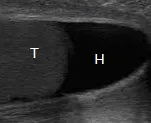 Hydrocele