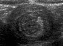 Intussusception target sign on ultrasound