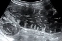 Large Bowel Obstruction
